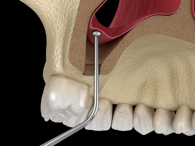Sinus lift procedure for dental implants at Shades Medical Center Dubai
