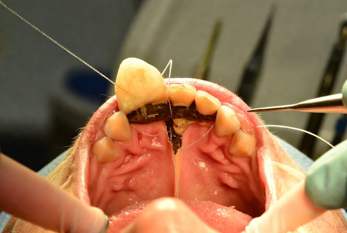 Gum Disease Treatment results at Shades Medical Center