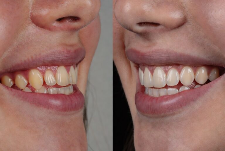 Orthodontic Retainers treatment results at Shades Medical Center