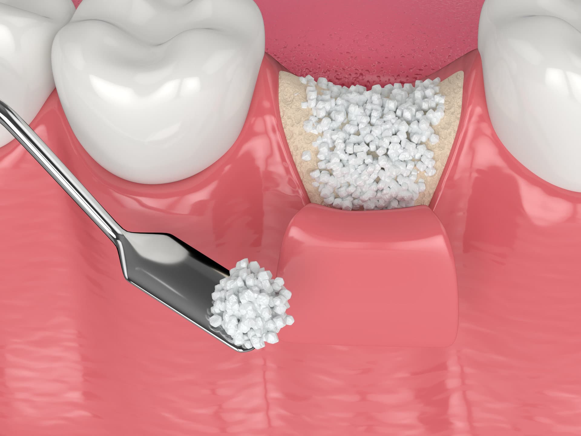 Socket preservation after tooth extraction at Shades Medical Center Dubai